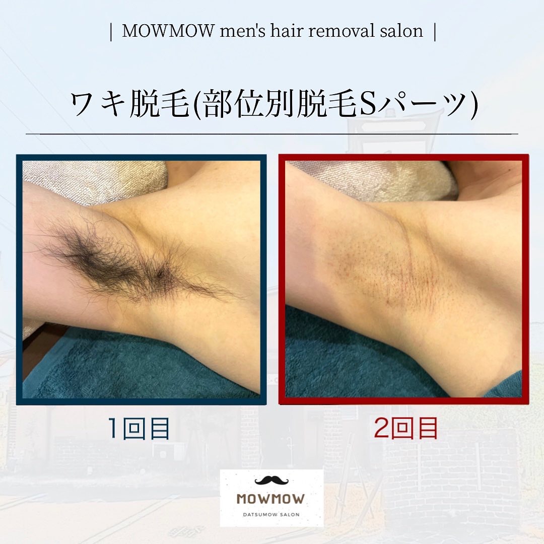 脱毛 効果 1 回目